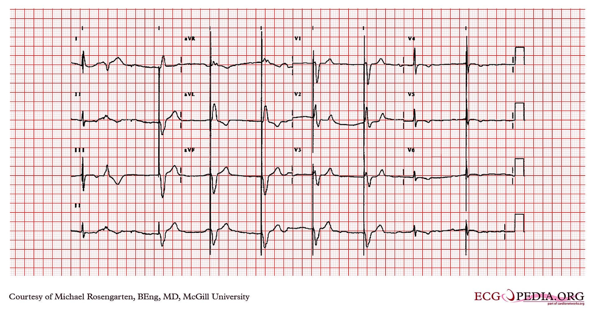 Electrocardiogram tracing showing sinus rhythm at about 50 beats per minute