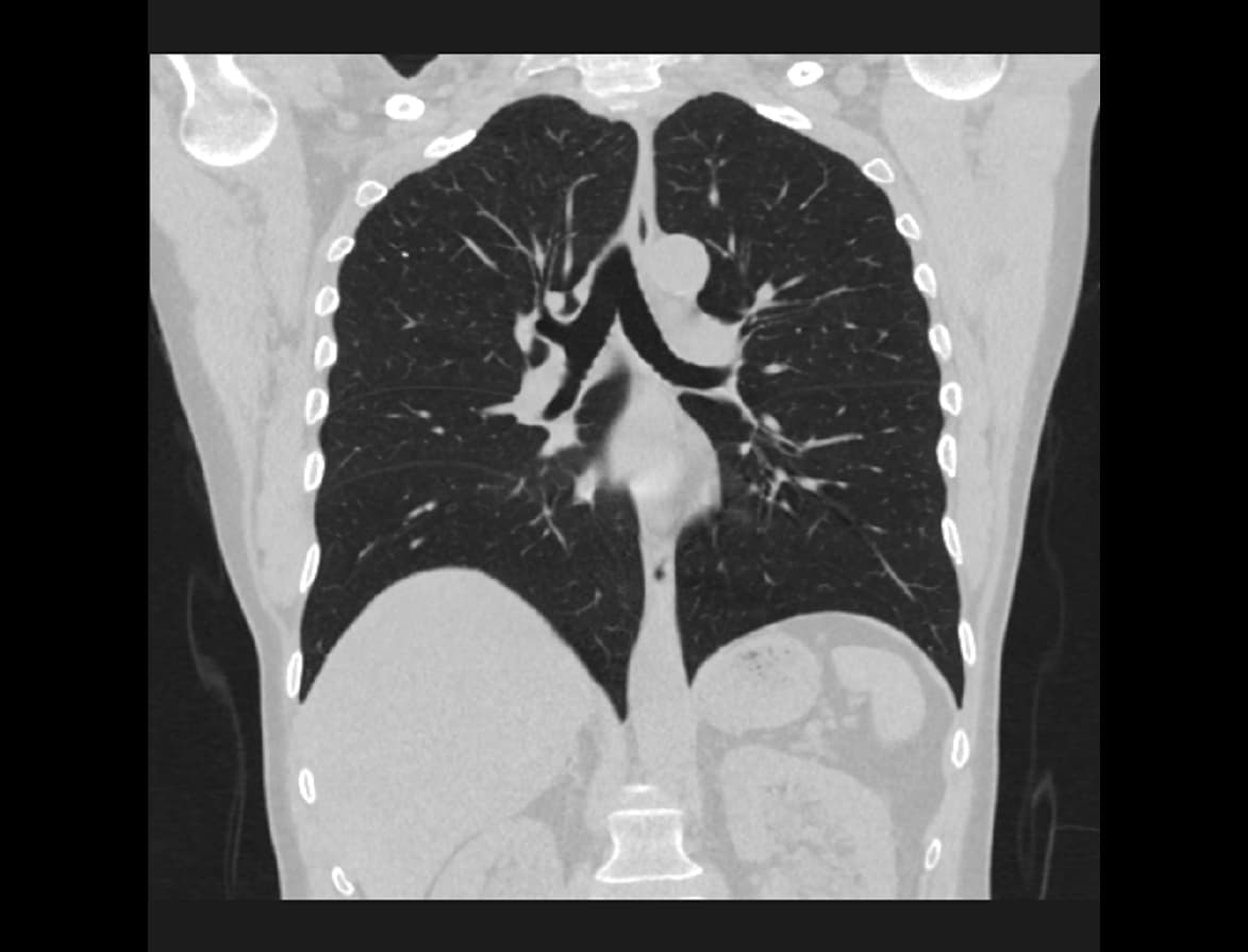 Low-dose CT scan of the thorax with coronal reconstruction showing the lungs