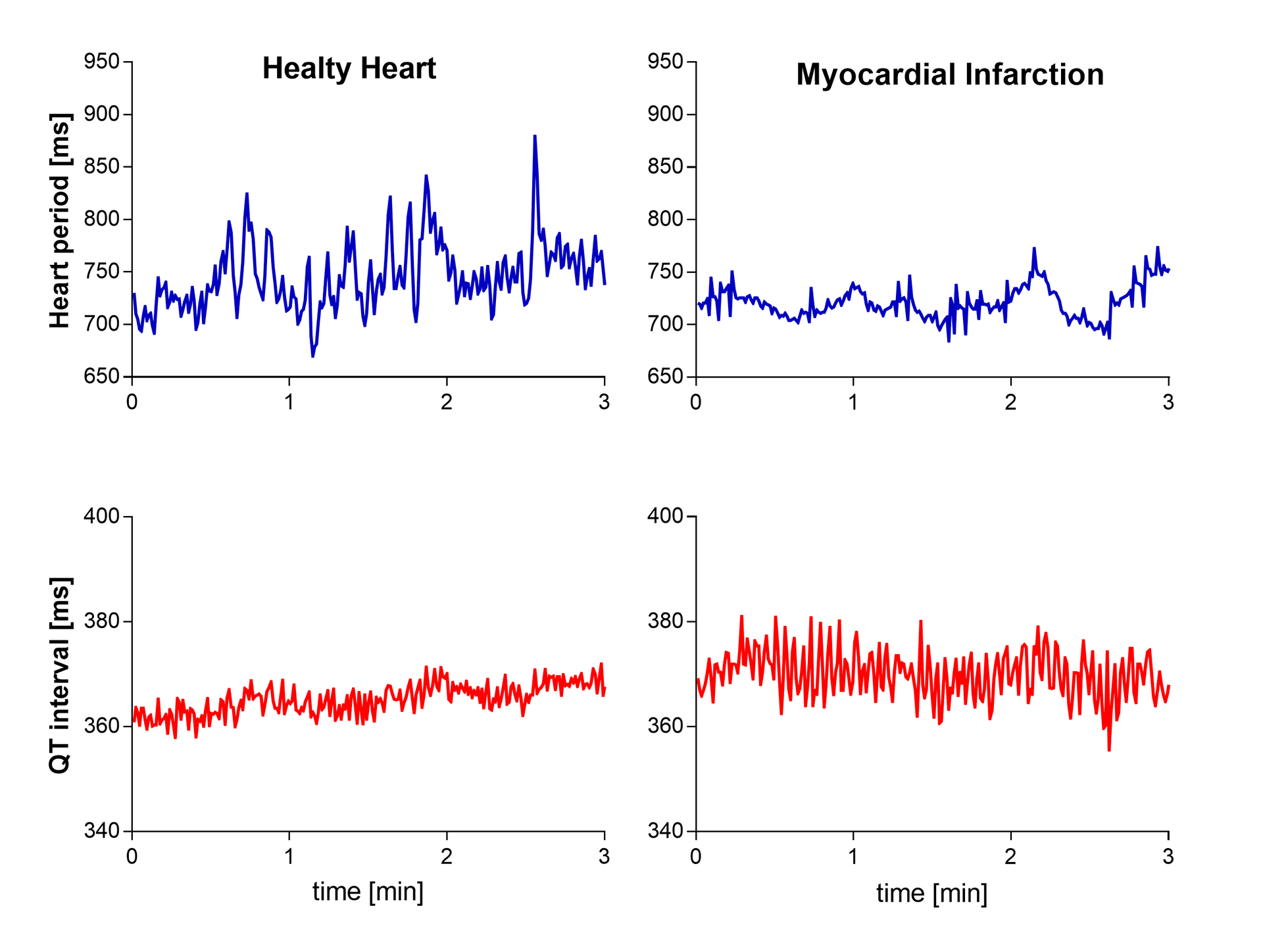 ECG traces showing beat-to-beat heart rate and QT interval variability