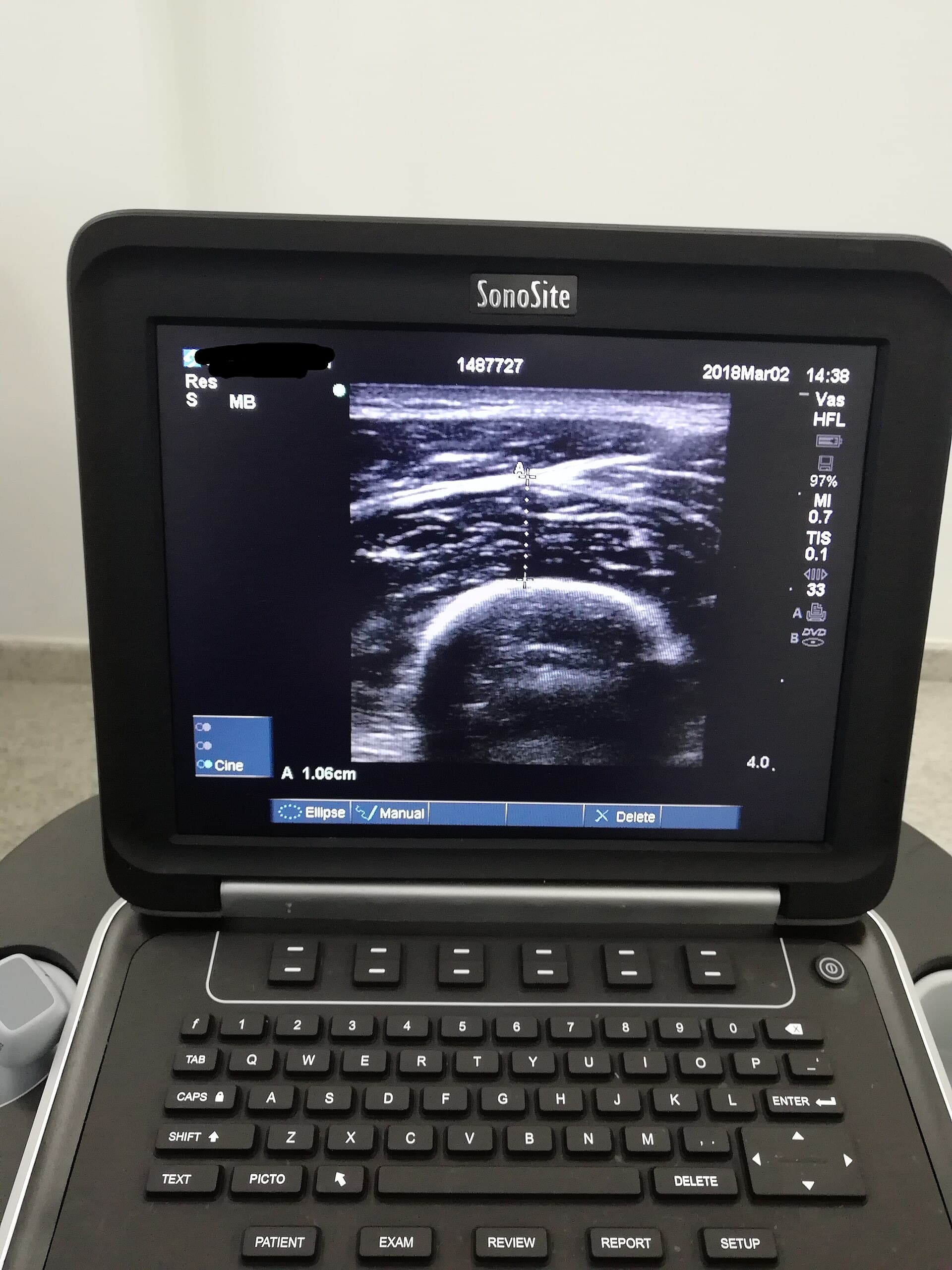 Ultrasound measurement of rectus femoris muscle thickness for clinical nutrition assessment